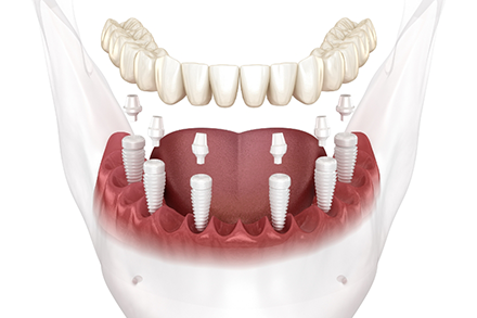 implant-supported bridge